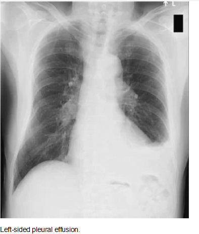 Left side pleural effusion