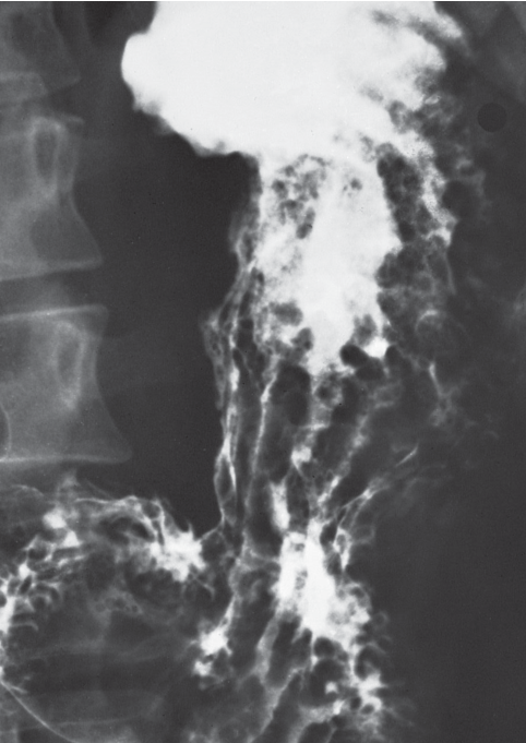 Ménétrier disease