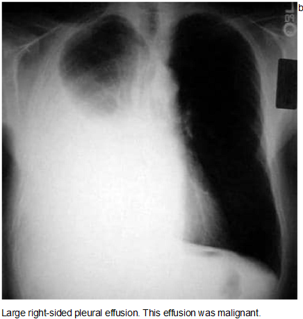 Pleural Effusion